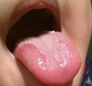 小孩草莓舌是怎么回事？