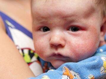 宝宝湿疹多久能自愈