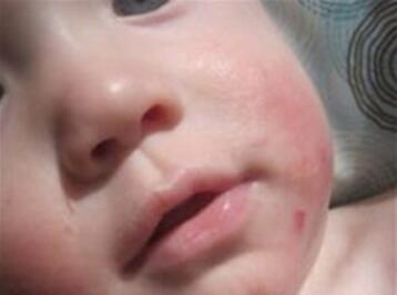 宝宝湿疹多久能自愈