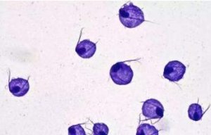 白带发黄是什么原因