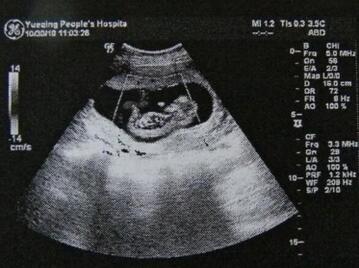 打胎药要多少钱一盒