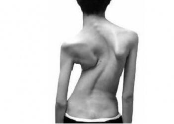 佝偻病的早期症状图片