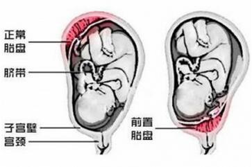 血性羊水的原因有哪些