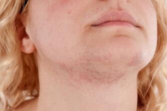 春天脸上起癣怎么办