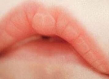 小儿口角炎会传染吗