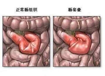 小儿肠套叠怎么治疗
