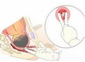 临产前吃什么能加快分娩产程