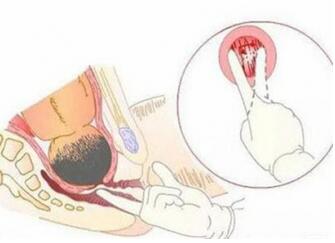 分娩吃什么能加快分娩产程