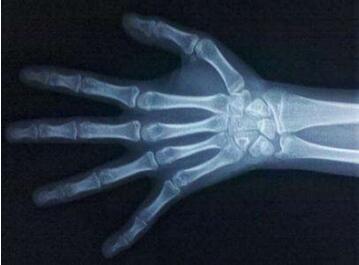 孩子测骨龄偏大的原因有哪些