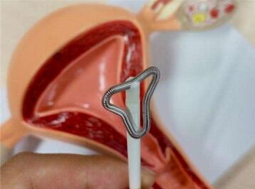 避孕环是什么 避孕环哪种好