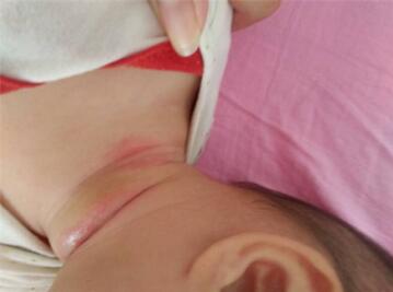 宝宝淹脖子是怎么回事