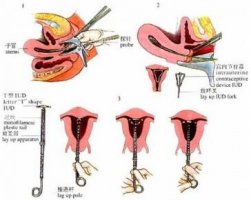 女人带环过程 副作用及注意事项
