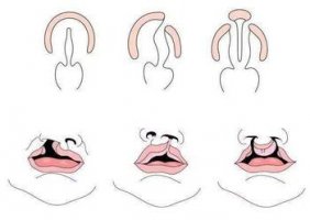 兔唇和唇腭裂的区别