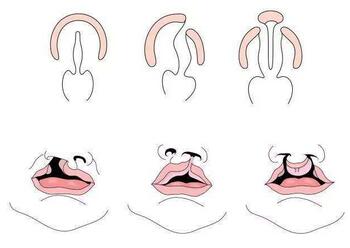 兔唇和唇腭裂的区别