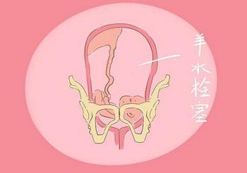 羊水栓塞是什么意思