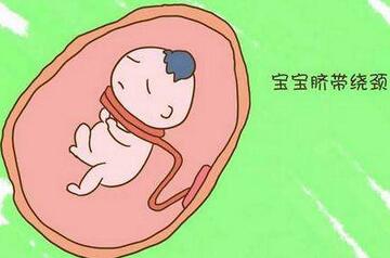 羊水少脐带绕颈一周能顺产吗