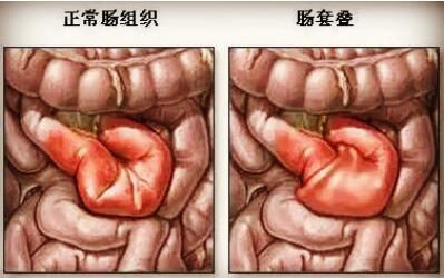 小儿肠套叠的危害