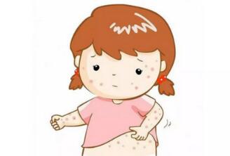 热痱子和湿疹的区别