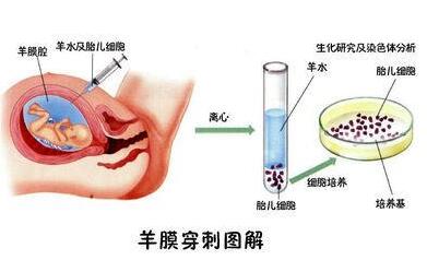 上海羊水穿刺费用