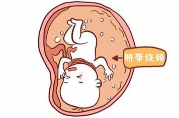 脐带绕颈两周怎么办