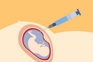 羊水穿刺怎么做