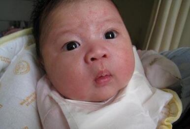 治疗新生儿脸上湿疹小妙招