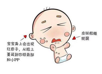 婴儿湿疹怎么办