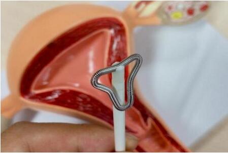 节育环怎么取的三步骤