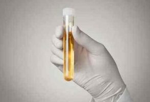 女性尿黄是什么原因引起的