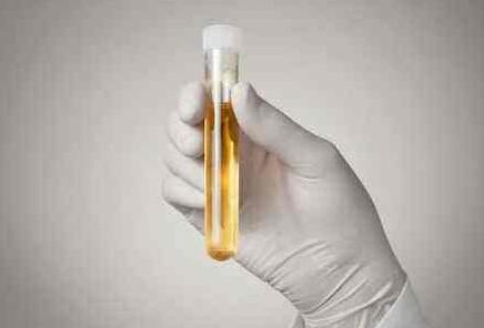 女性尿黄是什么原因引起的