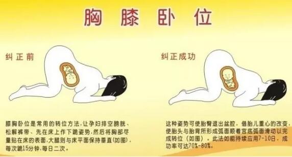 胎位不正的原因及纠正方法