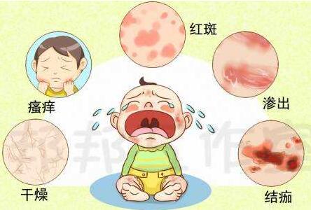 新生儿湿疹的症状及护理方法