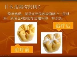 什么是窝沟封闭