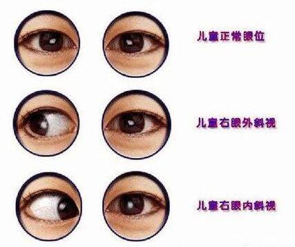 婴儿斗鸡眼怎么办