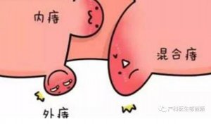 怀孕得了痔疮怎么办？不妨试试这几种方法
