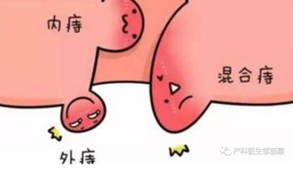 怀孕得了痔疮怎么办？不妨试试这几种方法