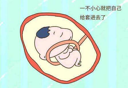 胎儿脐带绕颈怎么办