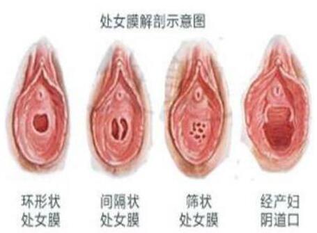 关于处女膜的5个问题，了解一下