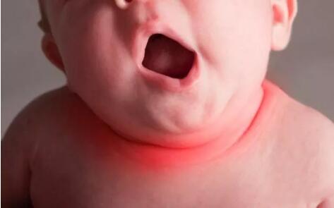 炉甘石洗剂和凡士林能搞定宝宝9种皮肤问题