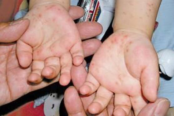 小孩口足手病轻微图片越早认识