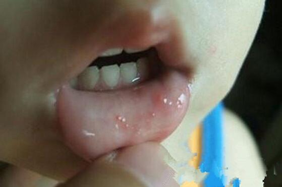 小孩口足手病轻微图片越早认识