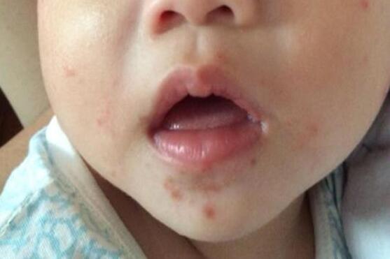 小孩口足手病轻微图片越早认识