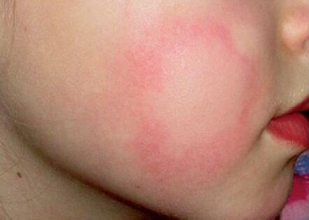 儿童荨麻疹