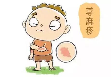 儿童荨麻疹
