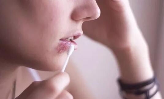 秋冬口角炎高发期，烂嘴角饮食注意事项