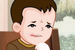 冬季应谨防小儿口角炎，小心病从口入！