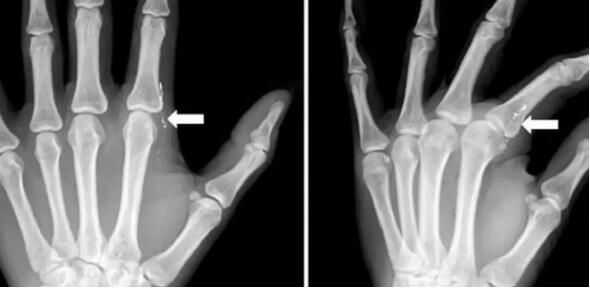 水银体温计将被禁止生产，别再给孩子用了