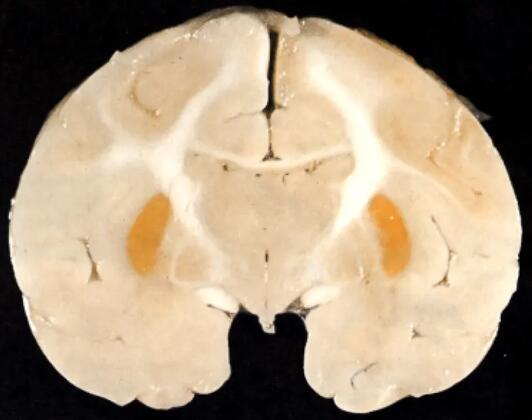 新生儿黄疸很常见，那需要医学干预吗？