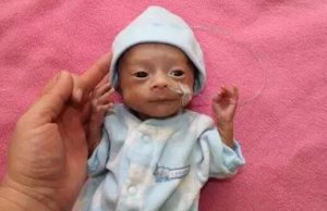 关注早产宝宝智力发育，预防脑瘫和智力低下