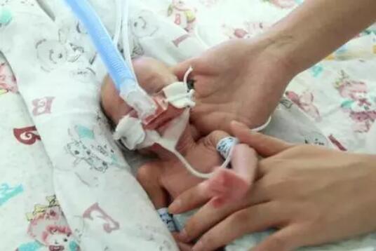 关注早产宝宝智力发育，预防脑瘫和智力低下